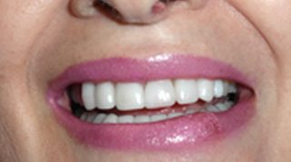 Smile with gap removed from front teeth