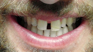 Smile with large gap between teeth