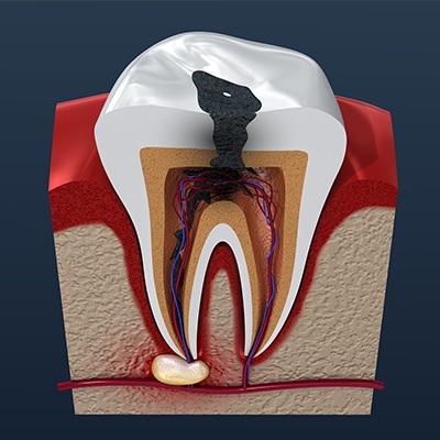 Animation of the inside of a tooth